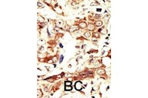 Formalin-fixed and paraffin-embedded human cancer tissue reacted with the primary antibody, which was peroxidase-conjugated to the secondary antibody, followed by AEC staining. (Insulin Receptor 抗体  (C-Term))