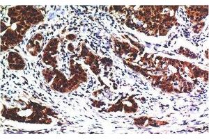 Immunohistochemistry of paraffin-embedded Human breast carcinoma tissue using AKT1 Monoclonal Antibody at dilution of 1:200. (AKT1 抗体)