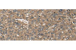 Immunohistochemistry of paraffin-embedded Human liver cancer tissue using CD1B Polyclonal Antibody at dilution of 1:55(x200) (CD1b 抗体)