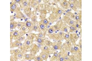 Immunohistochemistry of paraffin-embedded Human liver damage using GPD2 Polyclonal Antibody at dilution of 1:100 (40x lens). (GPD2 抗体)