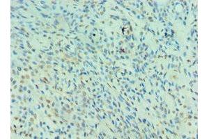 Immunohistochemistry of paraffin-embedded human breast cancer using ABIN7161130 at dilution of 1:100 (NEDD8 抗体  (AA 1-81))