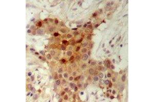 Immunohistochemical analysis of HER2 staining in human breast cancer formalin fixed paraffin embedded tissue section. (ErbB2/Her2 抗体  (C-Term))