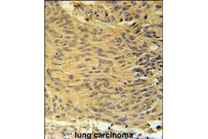 LCLT1 Antibody immunohistochemistry analysis in formalin fixed and paraffin embedded human lung carcinoma followed by peroxidase conjugation of the secondary antibody and DAB staining. (LCLAT1 抗体  (C-Term))