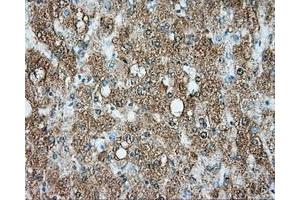 Immunohistochemical staining of paraffin-embedded Carcinoma of liver tissue using anti-SRR mouse monoclonal antibody. (SRR 抗体)