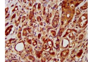 IHC image of ABIN7158186 diluted at 1:400 and staining in paraffin-embedded human pancreatic cancer performed on a Leica BondTM system. (LRRC45 抗体  (AA 222-357))