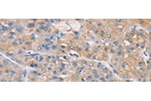 Immunohistochemistry of paraffin-embedded Human liver cancer tissue using ZADH2 Polyclonal Antibody at dilution of 1:100(x200) (ZADH2 抗体)