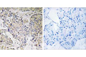Peptide - +Immunohistochemistry analysis of paraffin-embedded human breast carcinoma tissue using CEP41 antibody. (CEP41 抗体)