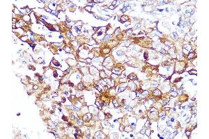 Immunohistochemistry of paraffin-embedded human esophageal cancer using Caveolin-2 Rabbit mAb (ABIN7266155) at dilution of 1:100 (40x lens). (Caveolin 2 抗体)