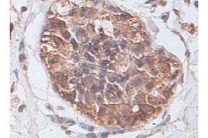 Immunohistochemical staining of formalin-fixed paraffin-embedded human prostate carcinoma tissue showing cytoplasmic and membrane staining with PTP4A2 polyclonal antibody  at 1 : 100 dilution. (PTP4A2 抗体  (AA 2-167))