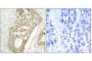 Immunohistochemical analysis of paraffin-embedded human breast carcinoma tissue, using PKC delta (phospho-Ser645) antibody. (PKC delta 抗体  (pSer645))