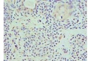 Immunohistochemistry of paraffin-embedded human breast cancer using ABIN7155290 at dilution of 1:100 (HAT1 抗体  (Catalytic Subunit))