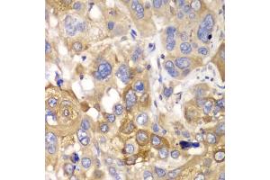 Immunohistochemistry of paraffin-embedded human esophageal cancer using PPP1CB antibody. (PPP1CB 抗体)