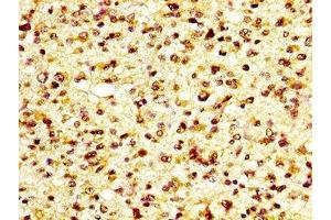 IHC image of ABIN7163593 diluted at 1:600 and staining in paraffin-embedded human glioma performed on a Leica BondTM system. (GP6 抗体  (AA 115-265))