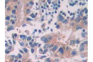 DAB staining on IHC-P; Samples: Human Prostate cancer Tissue (Tyrosine Protein Kinase 7 (AA 853-1070) 抗体)