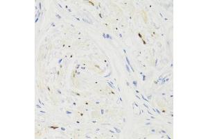 Immunohistochemistry of paraffin-embedded human breast cancer using GEMIN2 Antibody (ABIN5971577) at dilution of 1/100 (40x lens). (SIP1 抗体)