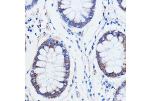 Immunohistochemistry of paraffin-embedded human colon carcinoma using TRIM16 antibody (ABIN7270978) at dilution of 1:100 (40x lens). (TRIM16 抗体  (AA 1-210))