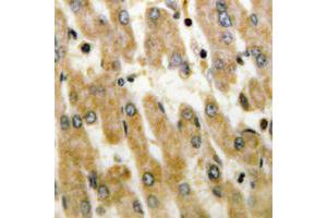 Immunohistochemical analysis of DUSP1/4 staining in human liver cancer formalin fixed paraffin embedded tissue section. (MKP-1/2 抗体  (C-Term))