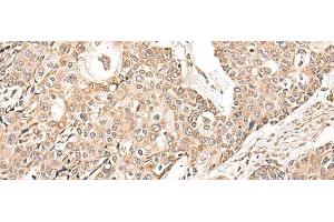 Immunohistochemistry of paraffin-embedded Human prost ate cancer tissue using NDUFB11 Polyclonal Antibody at dilution of 1:95(x200) (NDUFB11 抗体)