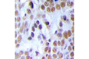 Immunohistochemical analysis of MCM3 staining in human breast cancer formalin fixed paraffin embedded tissue section. (MCM3 抗体)