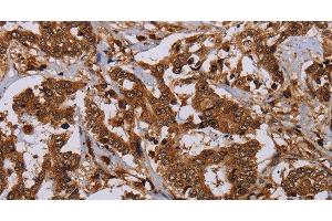 Immunohistochemistry of paraffin-embedded Human liver cancer using MOB1A Polyclonal Antibody at dilution of 1:30 (MOB1A 抗体)