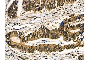 ABIN6257868 and ABIN6274110 at 1/100 staining Human colorectal cancer by IHC-P.