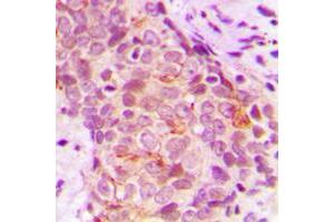 Immunohistochemical analysis of MARK3 staining in human breast cancer formalin fixed paraffin embedded tissue section. (MARK3 抗体  (N-Term))