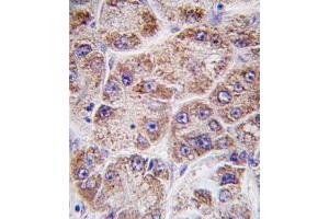 Formalin-fixed and paraffin-embedded human hepatocarcinoma tissue reacted with FDPS antibody (Center ) (ABIN389054 and ABIN2839263) , which was peroxidase-conjugated to the secondary antibody, followed by DAB staining. (FDPS 抗体  (AA 389-419))