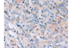 Detection of CAP3 in Human Prostate cancer Tissue using Polyclonal Antibody to Cytoplasmic Antiproteinase 3 (CAP3)