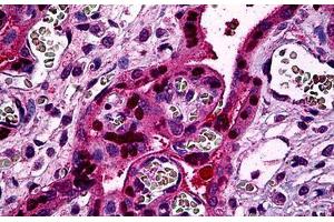 Immunohistochemistry (Formalin-fixed Paraffin-embedded Sections) (IHC (fp)) image for anti-Signal Transducer and Activator of Transcription 5B (STAT5B) (AA 678-788) antibody (ABIN626181)