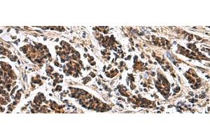 Immunohistochemistry of paraffin-embedded Human breast cancer tissue using ARPC1B Polyclonal Antibody at dilution of 1:65(x200) (ARPC1B 抗体)