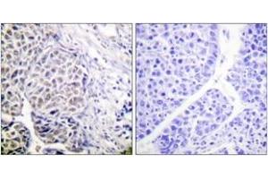 Immunohistochemistry analysis of paraffin-embedded human liver carcinoma, using AurB (Phospho-Tyr12) Antibody. (Aurora Kinase B 抗体  (pTyr12))