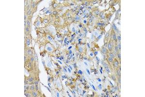 Immunohistochemistry of paraffin-embedded human lung cancer using R Rabbit mAb (ABIN7269840) at dilution of 1:100 (40x lens). (RALBP1 抗体)