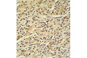 Immunohistochemistry analysis in formalin fixed and paraffin embedded prostate carcinoma reacted with HOXA3 / HOX1E Antibody (C-term) Cat. (HOXA3 抗体  (C-Term))