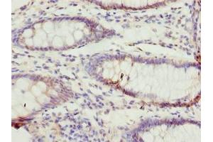 Immunohistochemistry of paraffin-embedded human colon cancer using ABIN7171939 at dilution of 1:100 (TTC38 抗体  (AA 2-200))