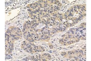 FGFR3 Mouse Monoclonal Antibody at 1/100 staining human lung cancer and adjacent non-tumor tissue by IHC-P. (FGFR3 抗体  (C-Term))