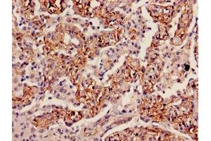 Immunohistochemistry of paraffin-embedded human lung cancer using ABIN7156215 at dilution of 1:100 (INMT 抗体  (AA 1-263))