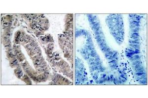 Immunohistochemical analysis of paraffin-embedded human colon carcinoma tissue using AMPKa1(Phospho-Ser487)Antibody(left) or the same antibody preincubated with blocking peptide(right). (AMPK alpha 抗体  (pSer487))