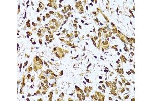 Immunohistochemistry of paraffin-embedded Human gastric cancer using KU70 Polyclonal Antibody at dilution of 1:100 (40x lens). (XRCC6 抗体)