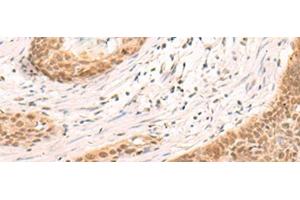 Immunohistochemistry of paraffin-embedded Human esophagus cancer tissue using SIX6 Polyclonal Antibody at dilution of 1:30(x200) (SIX Homeobox 6 抗体)