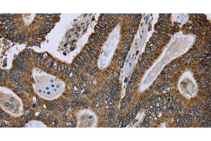 Immunohistochemistry of paraffin-embedded Human colon cancer using GOT2 Polyclonal Antibody at dilution of 1:50 (GOT2 抗体)