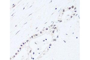 Immunohistochemistry of paraffin-embedded Human gastric cancer using BRIX1 Polyclonal Antibody at dilution of 1:100 (40x lens). (BRIX1 抗体)