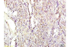 Formalin-fixed and paraffin embedded human cervical carcinoma labeled with Anti-CGA/ Chromogranin A Polyclonal Antibody, Unconjugated (ABIN669846) at 1:200 followed by conjugation to the secondary antibody and DAB staining (Chromogranin A 抗体  (AA 420-457))