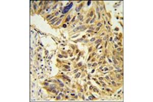 Immunohistochemistry analysis in Formalin Fixed, Paraffin Embedded lung carcinoma stained with SDR Antibody (Center) followed by peroxidase conjugation of the secondary antibody and DAB staining. (SDPR 抗体  (Middle Region))