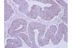 IHC-P Image Immunohistochemical analysis of paraffin-embedded human colon carcinoma, using PHKA2, antibody at 1:250 dilution. (PHKA2 抗体  (C-Term))