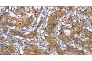 Immunohistochemistry of paraffin-embedded Human gastic cancer using CDC25A Polyclonal Antibody at dilution of 1:50 (CDC25A 抗体)