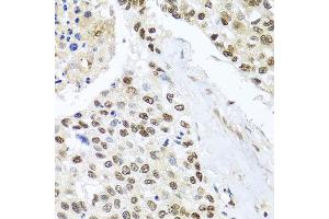 Immunohistochemistry of paraffin-embedded human lung cancer using BNIP3L antibody at dilution of 1:100 (x40 lens).