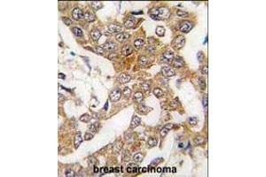 Formalin-fixed and paraffin-embedded human breast carcinoma tissue reacted with Bcl-w BH3 Domain Antibody (ABIN388097 and ABIN2846167) , which was peroxidase-conjugated to the secondary antibody, followed by DAB staining. (BCL2L2 抗体  (AA 24-59))