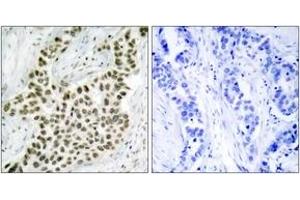 Immunohistochemistry analysis of paraffin-embedded human breast carcinoma tissue, using Histone H2A. (H2AFX 抗体  (AA 94-143))