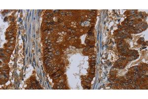 Immunohistochemistry of paraffin-embedded Human esophagus cancer using ERBB4 Polyclonal Antibody at dilution of 1:40 (ERBB4 抗体)