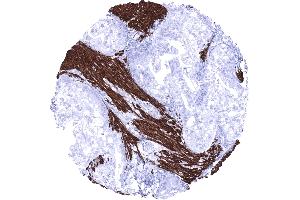 Stomach Gastric adenocarcinoma invading desmin positive smooth muscle fibres (Recombinant Desmin 抗体)